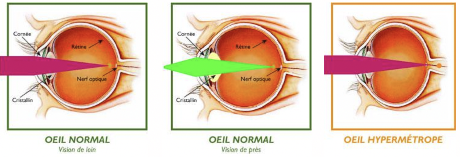 hypermétropie vs oeil normal