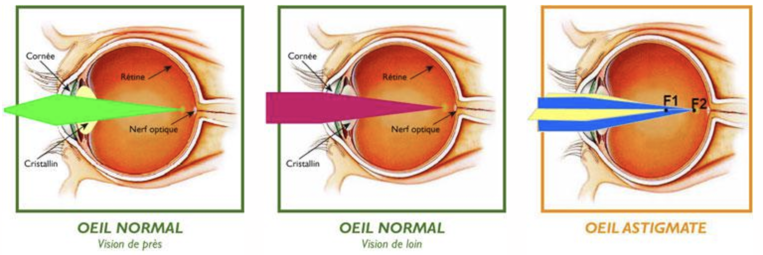 astigmatisme
