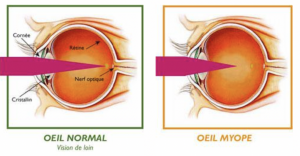 myopie schema