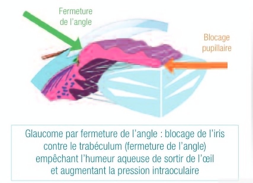 schéma glaucome fermeture angle