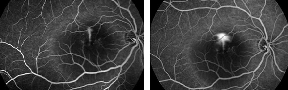 Angiographie en fluoresceine