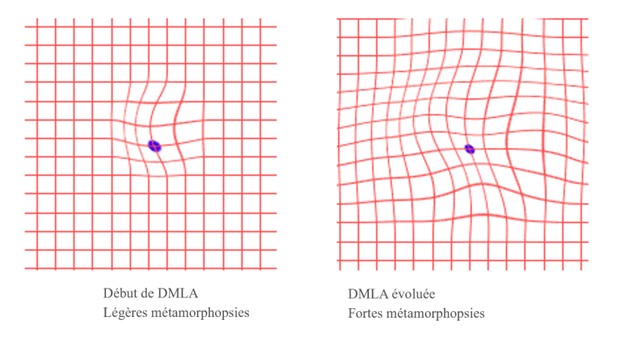 Grille d'Amsler DMLA