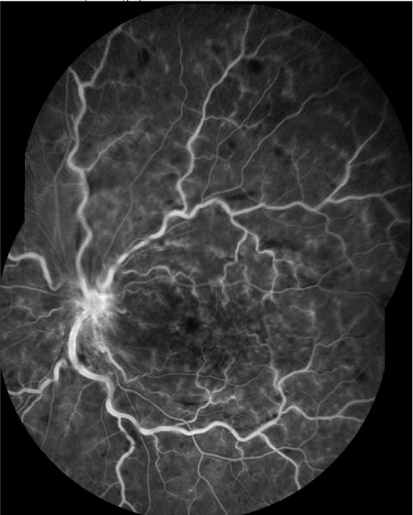 Occlusion de veine centrale de la rétine