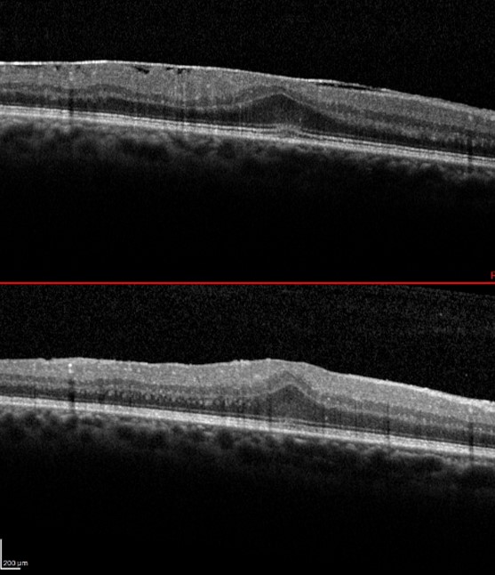 pelage de la membrane maculaire