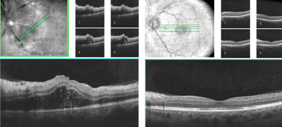 injections intra vitréennes