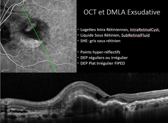 DMLA Exsudative