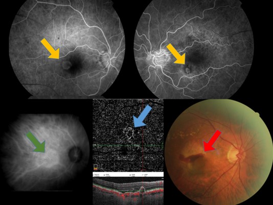 angiographie en fluorescéine