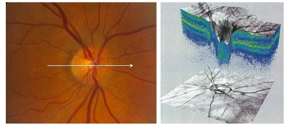 tomographie par cohérence optique