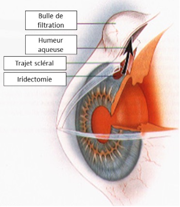 chirurgie du glaucome